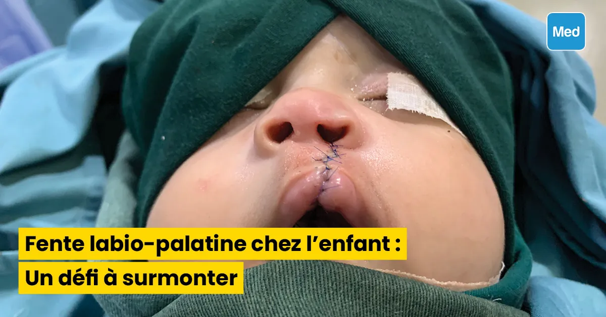 Fente labio-palatine chez l'enfant : Un défi à surmonter